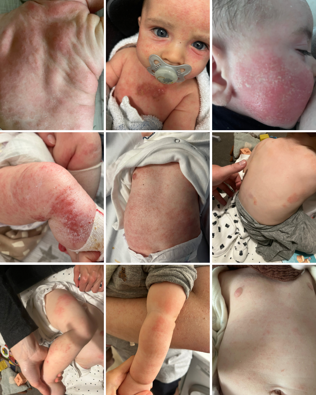 Part One 〰️ Our Eczema Journey